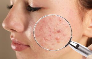 ACNE-PRONE-SKIN