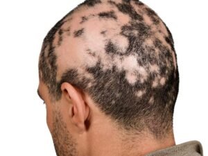 alopecia-2